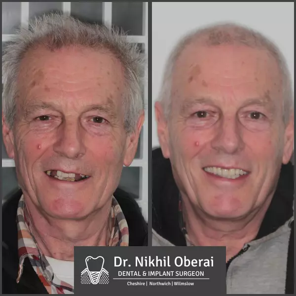 Dental implants before & after wilmslow & Northwich 1