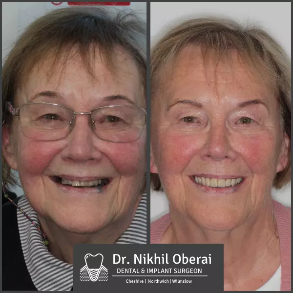Dental implants before & after wilmslow & Northwich 2