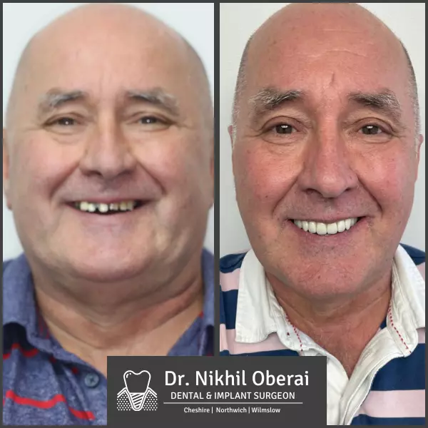 Dental implants before & after wilmslow & Northwich 5