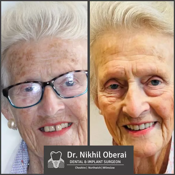 Dental implants before & after wilmslow & Northwich 8