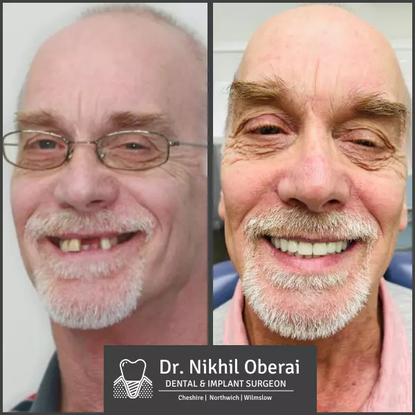 Dental implants before & after wilmslow & Northwich 9