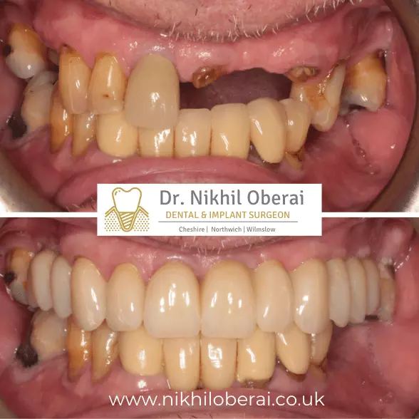 Dental implants before & after 8
